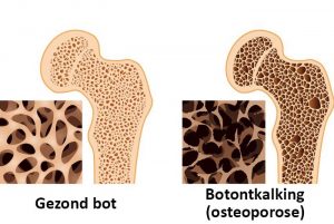 Informatie avond osteoporose 19 mei 2025